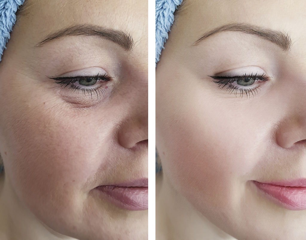 Geschwollene Augen - 5 Tipps die dir Linderung verschaffen - wer-weiss-was.de